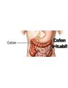 Colon Iritabil