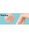 Varice